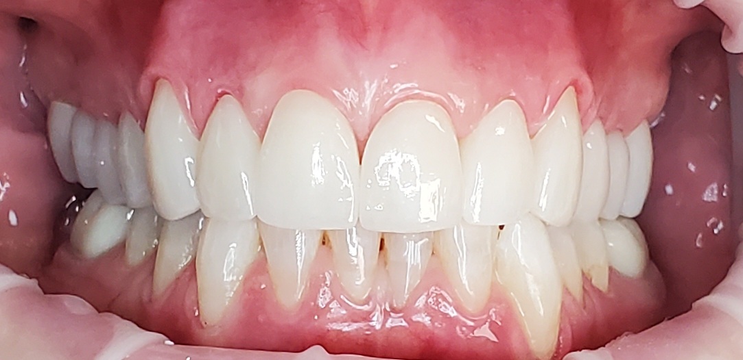 Cosmetic dentistry after treatment at Elm Ridge Implant and Family Dentistry in Killeen, TX
